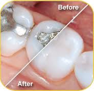 Replace metal fillings.